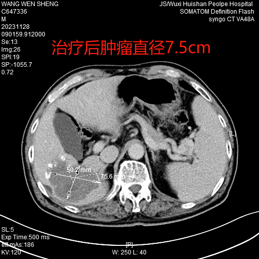 5治疗后.png